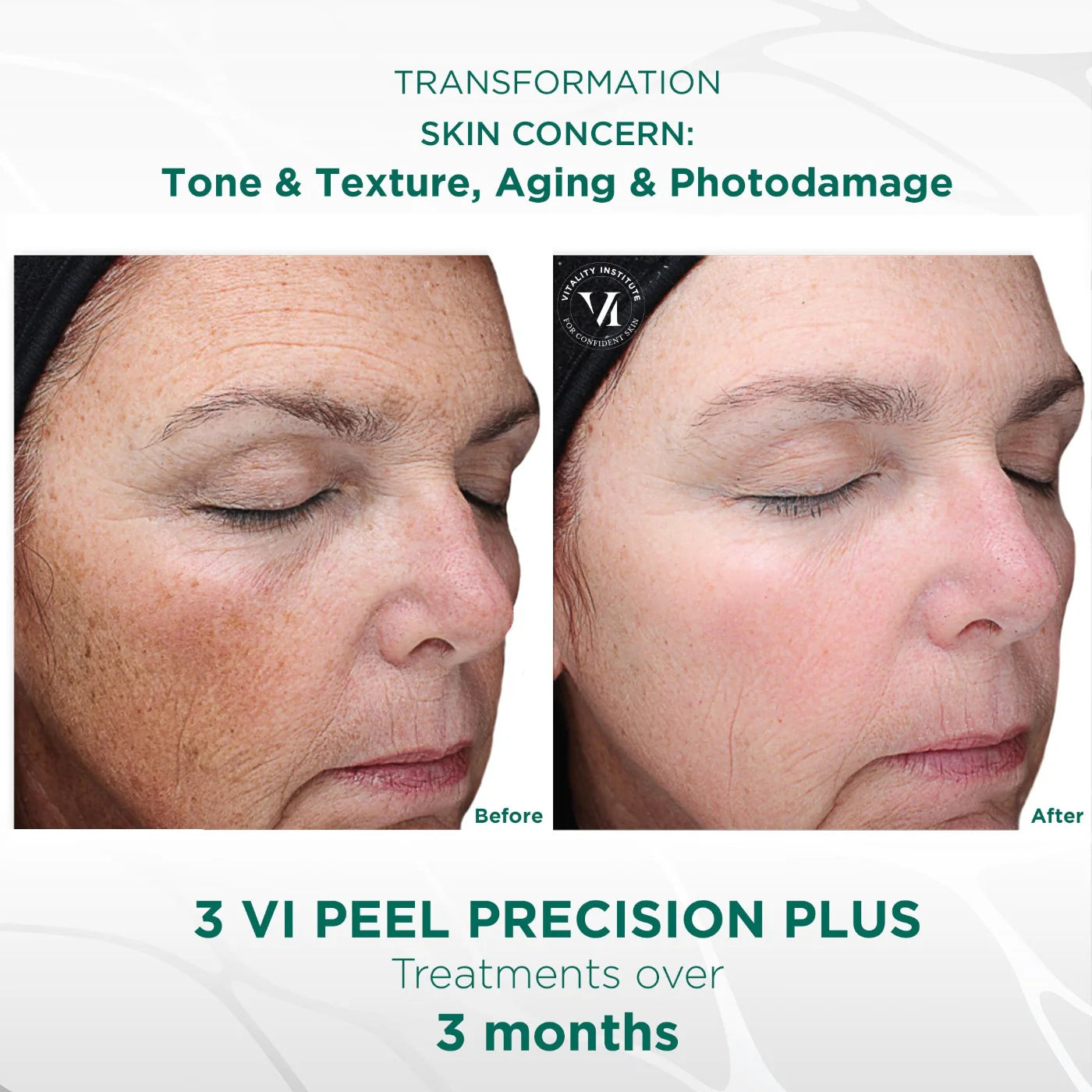 VI Peel Precision Plus