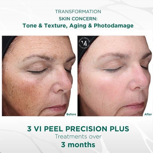 VI Peel Precision Plus